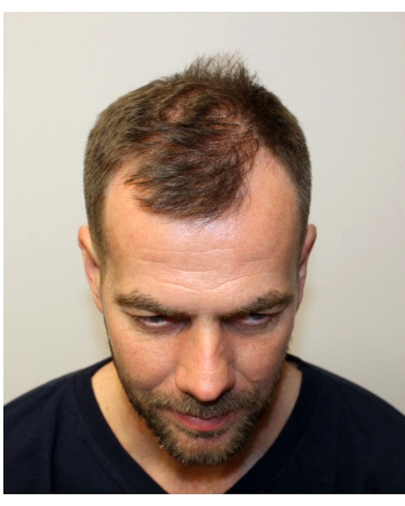 Top down view of a man with thinning forelock and visible scalp at the front of the hairline