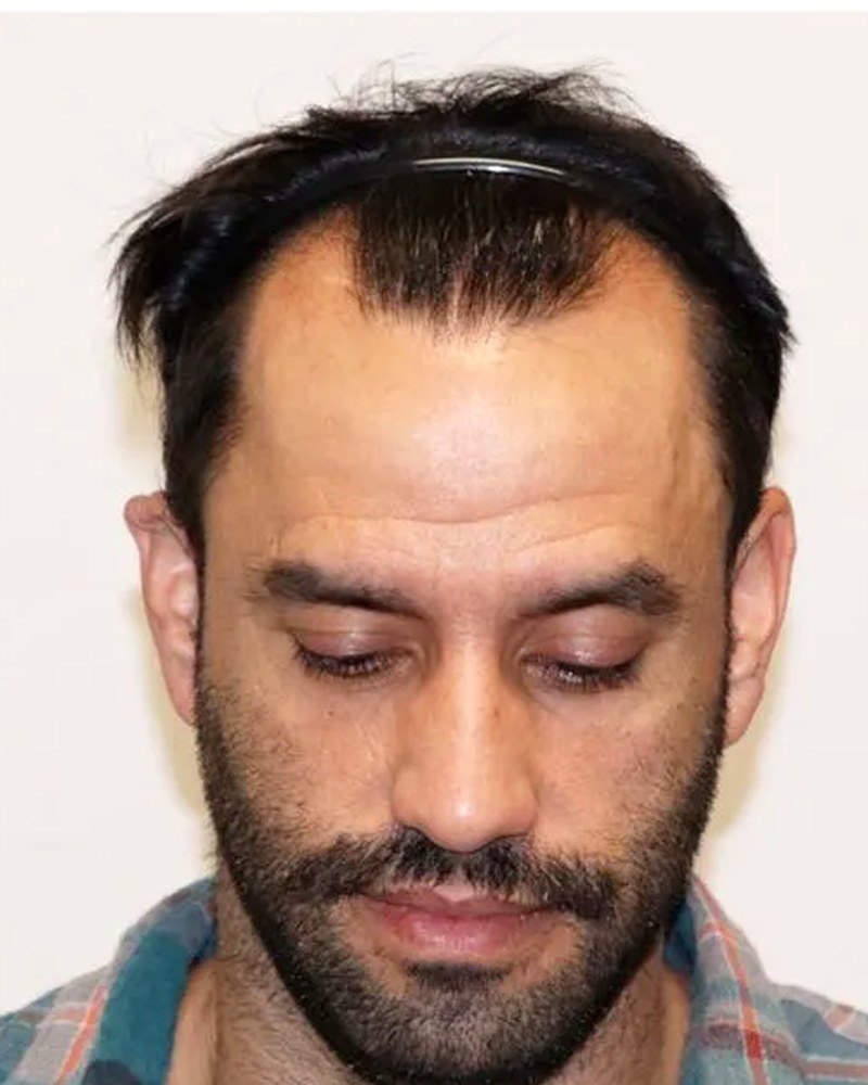 Top down view of a man with thinning crown and recessed temples