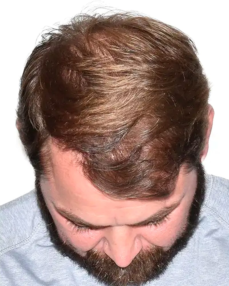 Same man's crown with full, naturally moving hair after a LiteStyle Transformation