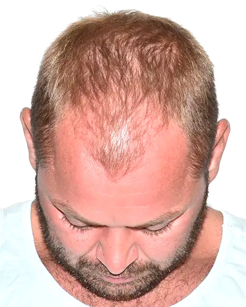 Top down view of a man with diffuse thinning across the crown