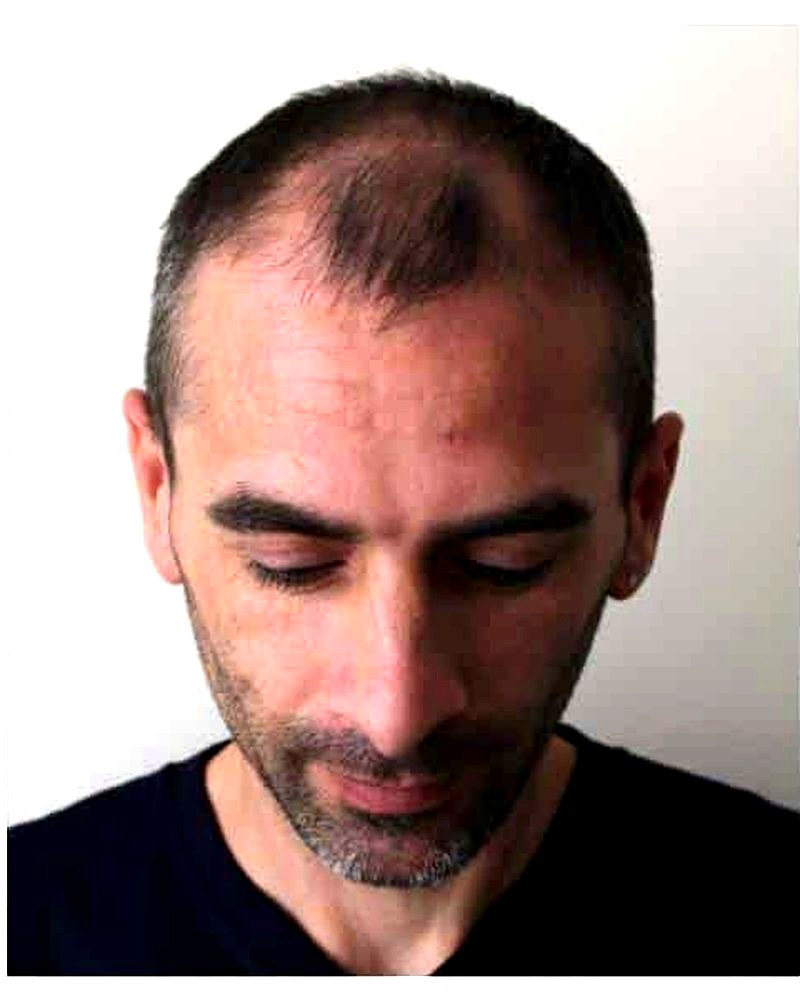 Top down view of a man with patchy density across the top of the head