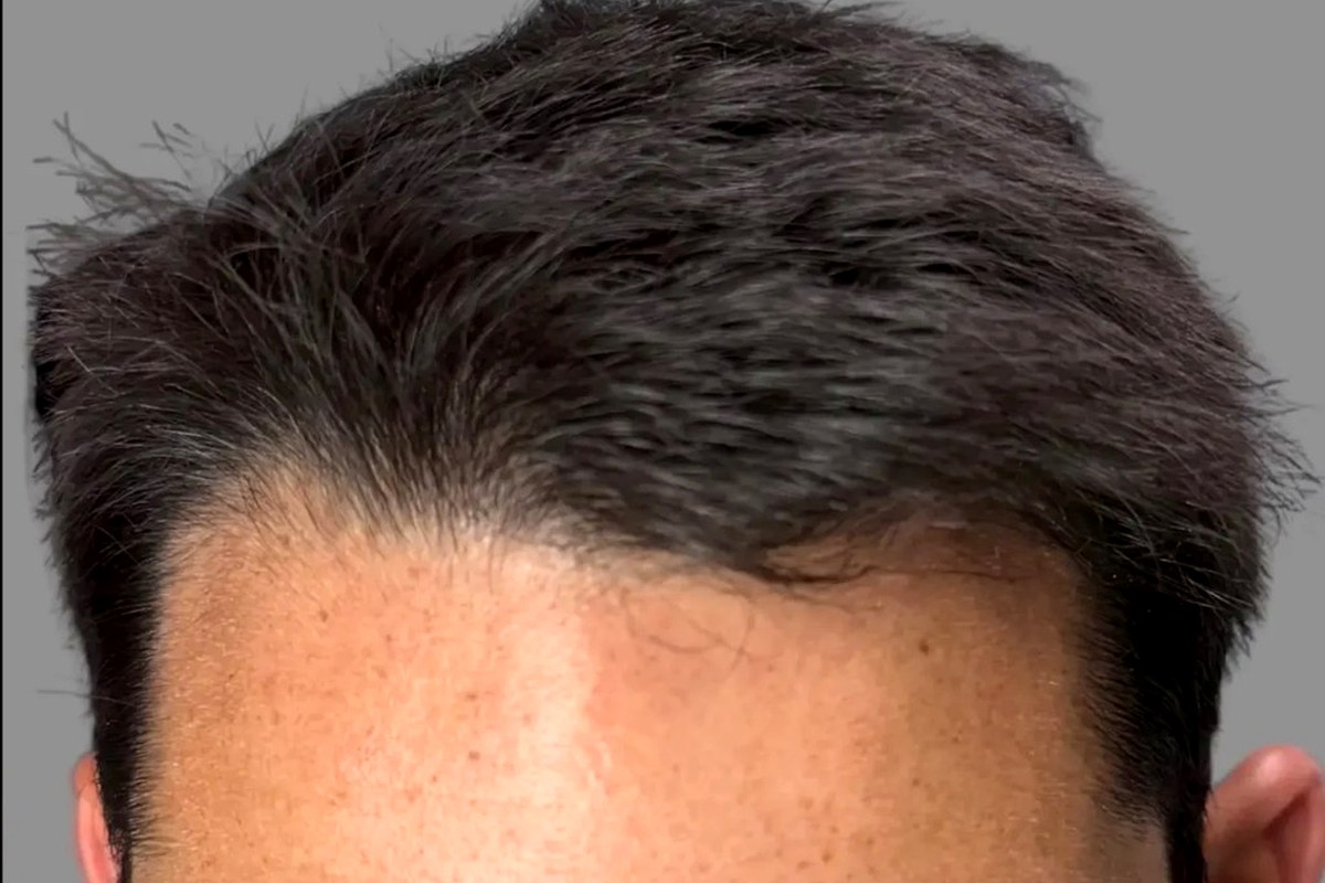 Top down view of the same man's crown after a LiteStyle Transformation showing full natural density