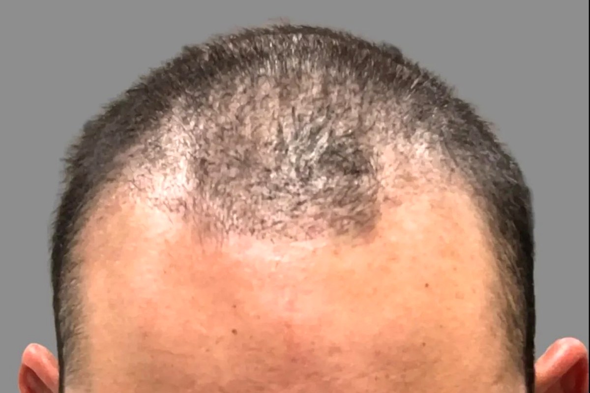 Top down view of a man's crown showing thinning density before a LiteStyle Transformation